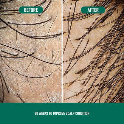 PHOFAY MINOXIDIL ANTI-HAARAUSFALL-MOUSSE 